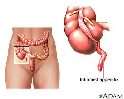 Location Of Appendix In Human